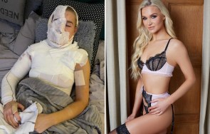 Dancer Abby Quinnen Poses In Her Underwear After Recovering From A Severe Burn.