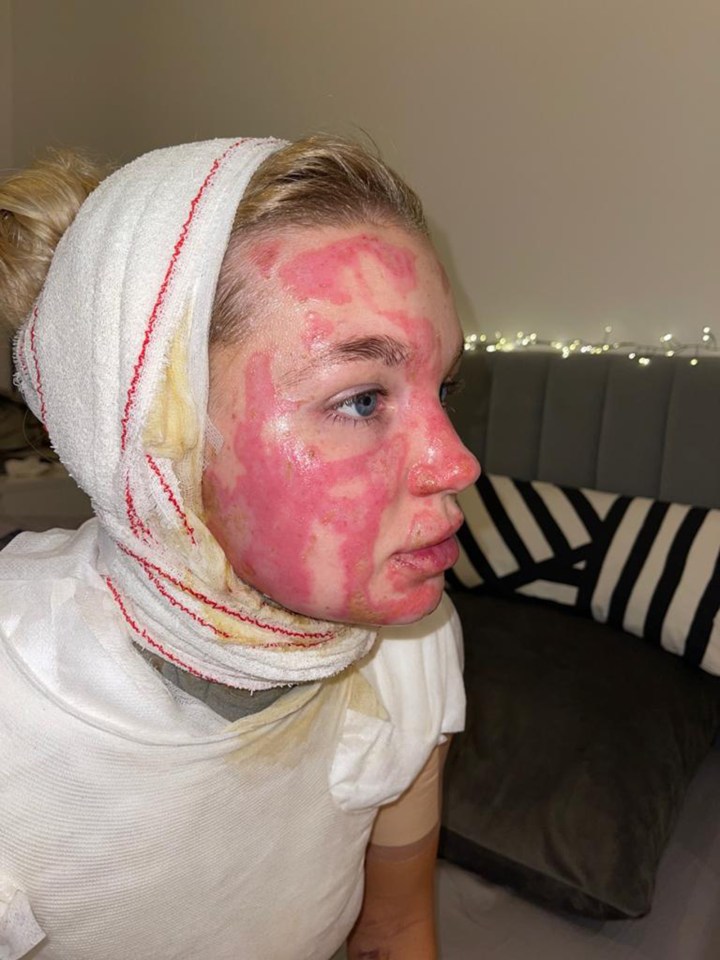Abby Suffered Third-Degree Burns After A Social Media Stunt With Aj Last January Went Wrong.